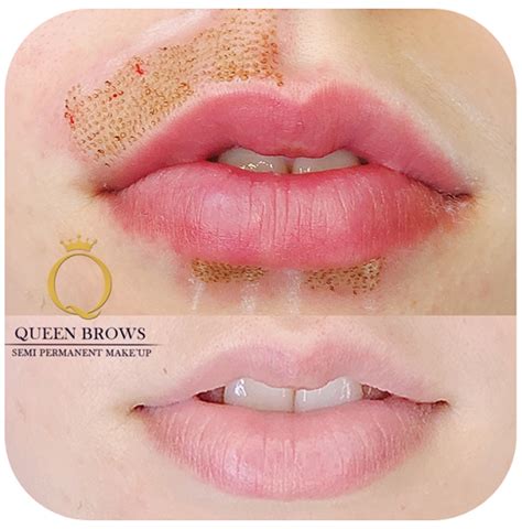 How long does it take for botox lip flip to kick in. Non-Surgical Lip Flip | Plasma Pen - Queen Brows