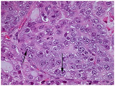 Nuclear Atypia Resumes In Larger Adenocarcinoma Lesions High Power