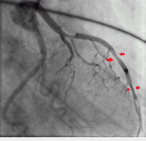 Coronary Angiography Showing The Mid Left Anterior Descending Artery