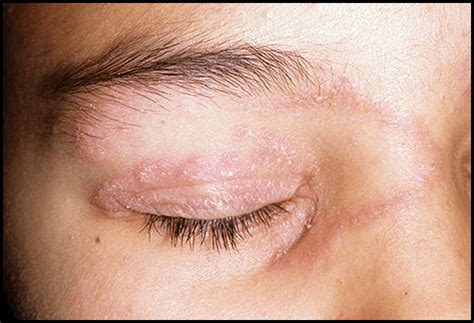 7 Causes and Effective Home Remedies to Get Rid of Eyelid ...