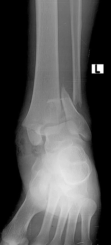 Ankle Fracture Weber C Image