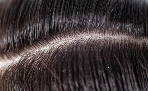 I aim to answer this very question below. Scales Of Dandruff In A Man`s Black Hair. The Concept Of ...