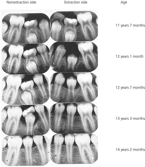 Eruption And Shedding Of Teeth Pediatric Dentistry A Clinical