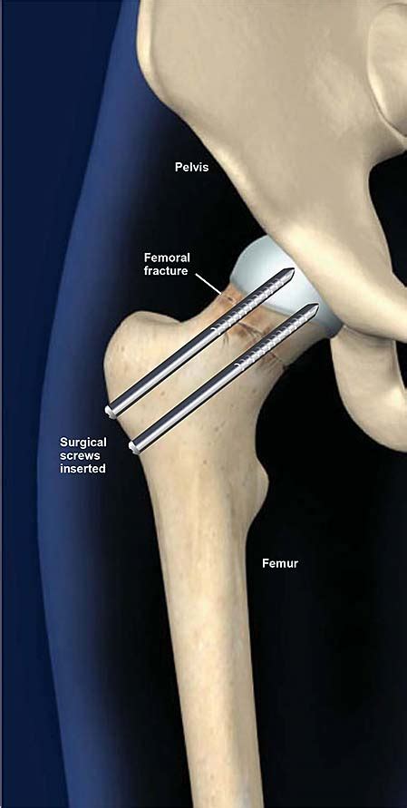 Hip Fracture Treatment With Surgical Screws Central Coast Orthopedic