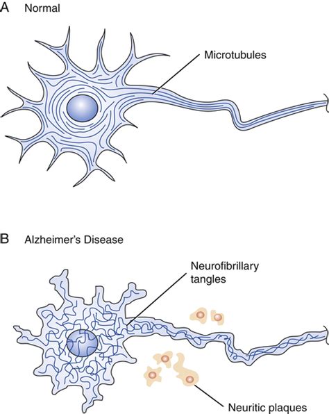 Alzheimers Disease Nurse Key