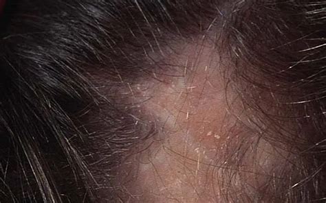 Unterseite Aufregend Westen Lupus And Laser Hair Removal Ankündigung