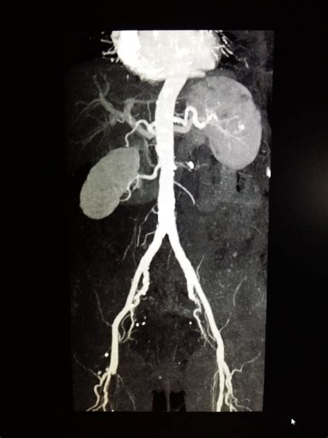 Multidetector Ct Scan Of The Abdominal Aorta Shows