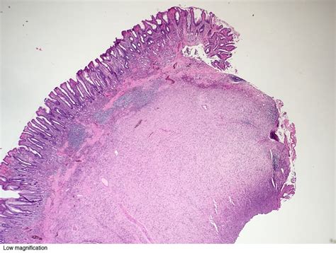 Pathology Outlines Inflammatory Fibroid Polyp