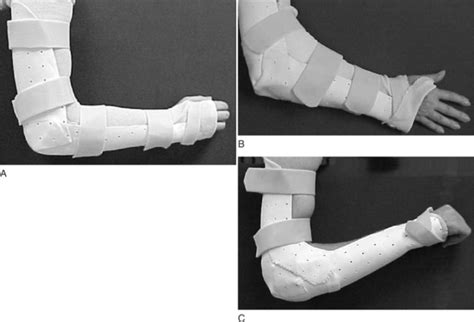 Elbow Immobilization Splints Musculoskeletal Key