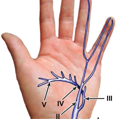 Shea And Mcclains Subdivision Of The Lesions Of Ulnar Nerve In The