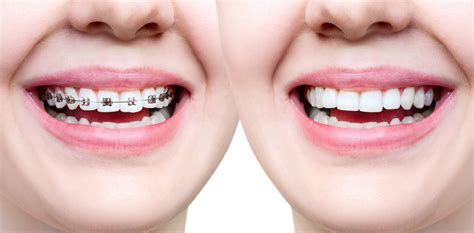 How To Choose Between Traditional Dental Braces Or Invisalign Smiles