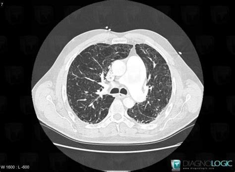 We did not find results for: Radiology case : Centrilobular emphysema (X rays ,CT ...