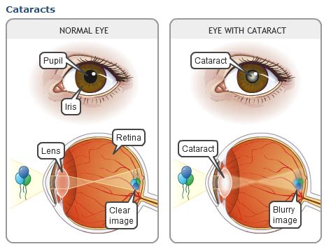 Lasik surgeon will first create a very thin, exterior flap in your cornea with a small surgical tool called microkeratome. Cataract: A Brief Overview | MEDCHROME