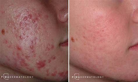 Acne And Acne Scarring Pima Dermatology
