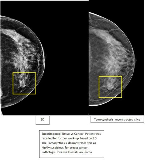 3d Mammography Advances Breast Cancer Detection News Sports Jobs