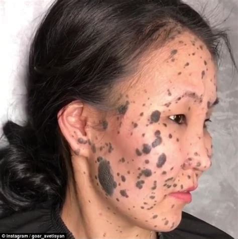 Woman Born With Moles On Her Face Reveals Transformation Daily Mail