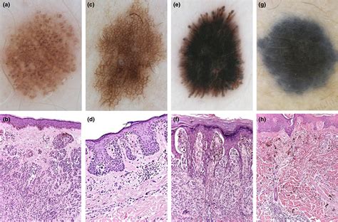 Abundance Of The Benign Melanocytic Universe Dermoscopic