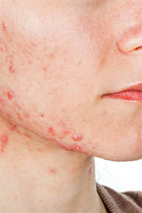 Breakouts On The Jawline Causes And Treatments Justinboey