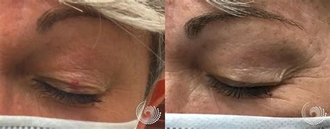 Laser Treatments Before And After Cherry Angioma
