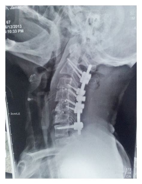 Postoperative Lateral Cervical Radiograph 3 Level Acdf And C2 To C7