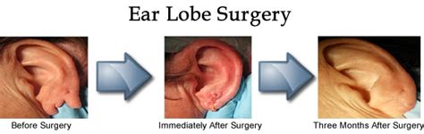 Ear Lobe Repair Associates In Dermatology