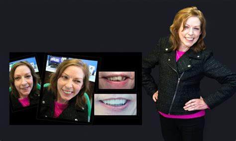 Cosmetic Dentistry Smile Makeovers Before And After Photos