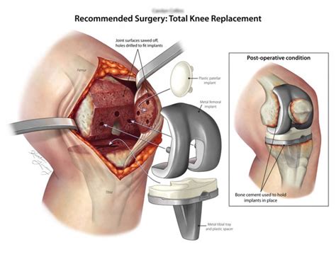 Total Knee Replacement Kaitlin Lindsay
