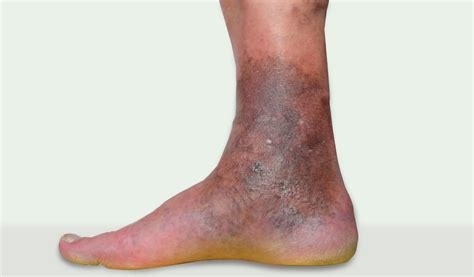 What Is Chronic Venous Insufficiency Avis Hospitals