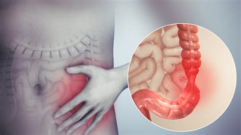 What Is Irritable Bowel Syndrome General Center