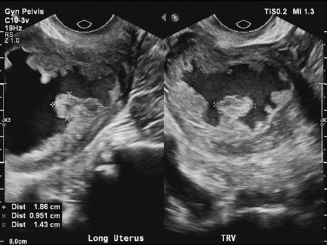 Sonographic Presentation Of Endometrial Carcinoma Stage I A Case Study