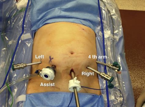 Figure 1 From Robot Assisted Laparoscopic Retroperitoneal Lymph Node
