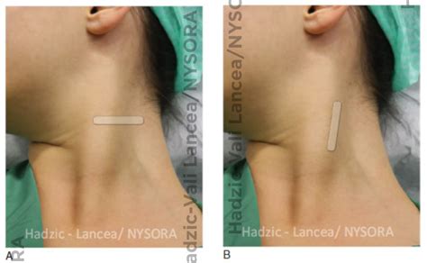 Ultrasound Guided Cervical Plexus Nerve Block Nysora 2022 Images And