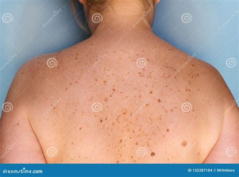 Big Birthmarks And Freckles On The Girl S Skin Medical Health Photo Of