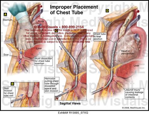 A chest tube is a hollow, flexible tube placed into the chest. Improper Placement of Chest Tube Medical Exhibit MediVisuals