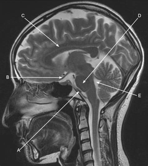 Magnetic Resonance Imaging Of The Sagittal Structures In The Brain