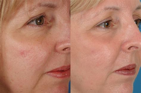 Laser Treatment Before And After Photos Dr Bassichis
