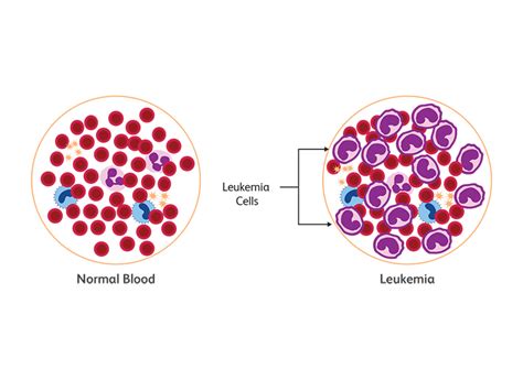 What Is Leukemia Types Of Leukemia Leukemia Causes
