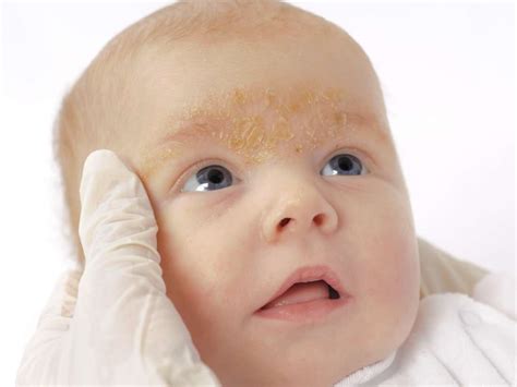 Rash On A Babys Face Pictures Causes And Treatments Health News 2 Me
