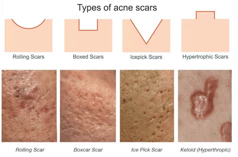 What Really Happens When You Get Laser Treatments For Acne Scars M