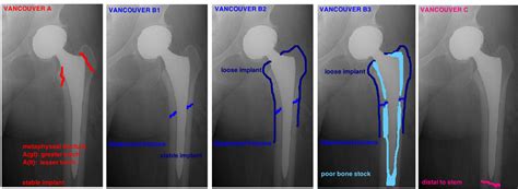 Typically in elderly, osteoporotic patients. PERIPROSTHETIC FRACTURE — Hip & Knee Book