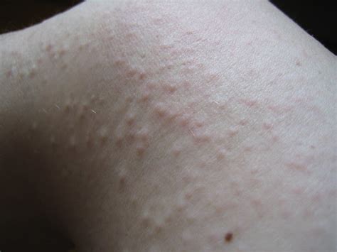 Relief For Hives Chronic Hives