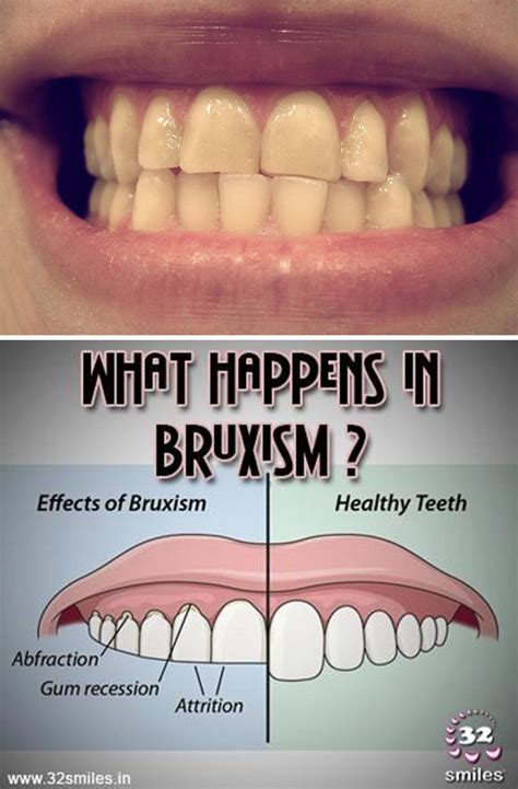 Many of those with anxiety clench their teeth at night how to stop your anxiety jaw pain. Grinding Your Teeth | Grinding teeth, Bruxism, Jaw clenching