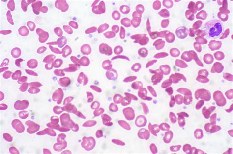 Whats Causing Heart Complications In Sickle Cell Anemia Pat
