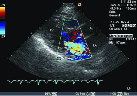 Color Doppler Echocardiography In The Evaluation Of Ventricular Septal