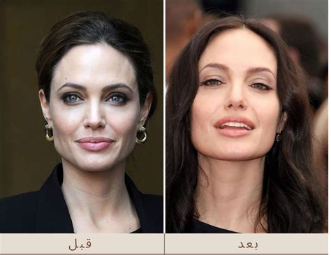 انجلينا جولي قبل و بعد مركز الصحة والجمال في تركيا