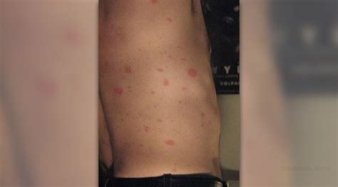 Options For Pityriasis Rosea Treatment Skin And Hair Problems Articles