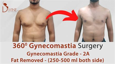 360 Degree Gynecomastia Surgery Result Gynecomastia Grade 2a Before