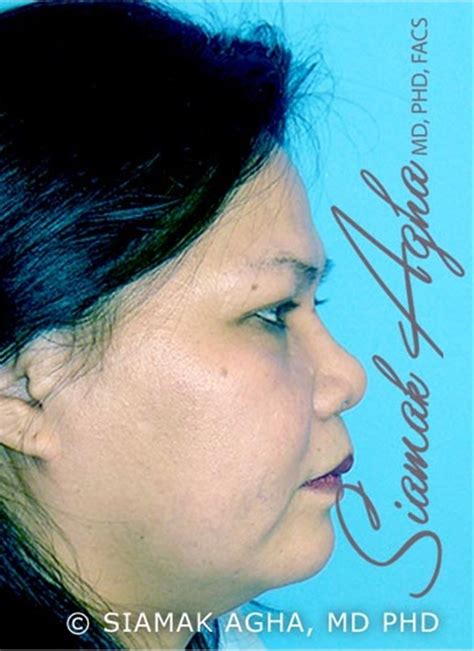 Rhinoplasty Before And After Photos By Siamak Agha Md Phd Facs Newport Beach Ca Case 43846