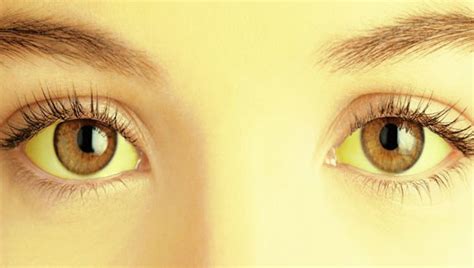 Ojos amarillentos o Ictericia Qué lo causa y cómo se trata