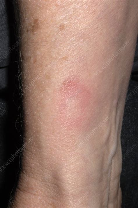Drug Induced Rash On Wrist Stock Image M3200497 Science Photo